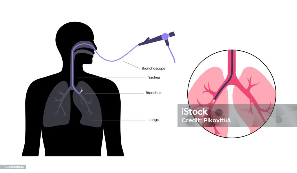Bronchoscope Position Bronchoscopy Procedure Concept Stock Illustration - Download Image Now ...