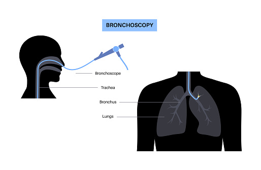 Bronchoscope Position Bronchoscopy Procedure Concept Stock Illustration - Download Image Now ...