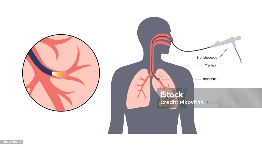 Bronchoscope Position Bronchoscopy Procedure Concept Stock Illustration - Download Image Now ...