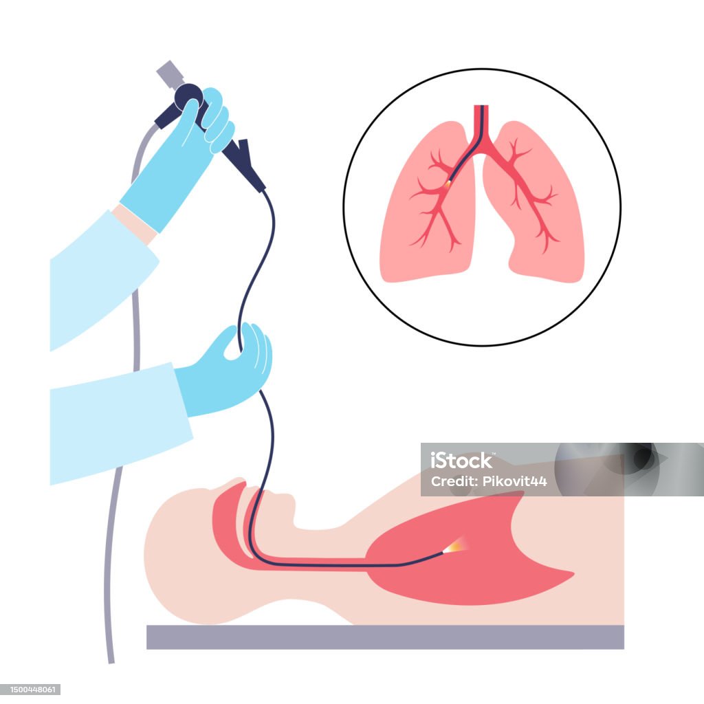 Bronchoscopy Visualization Bronchoscopy Procedure Concept Stock Illustration - Download Image Now ...