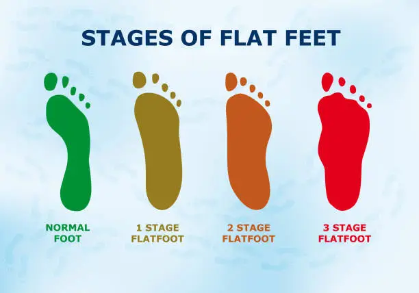 Vector illustration of Educational poster about flat feet, different stages of the disease.