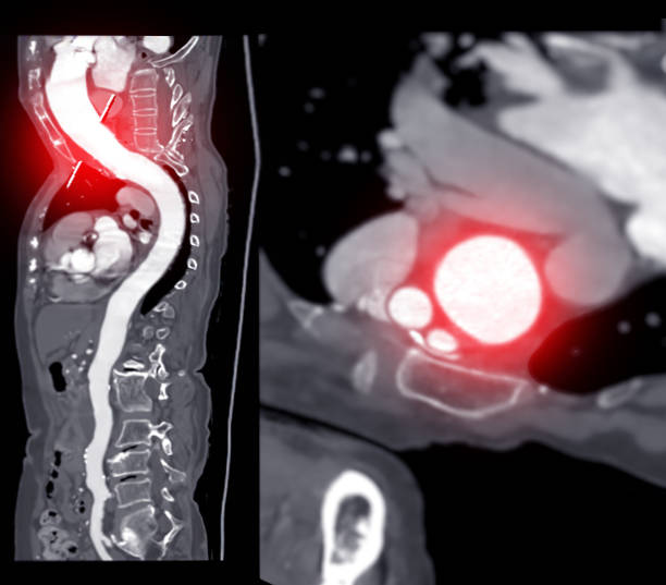 istock CTA whole aorta MPR Curve. 1500734141