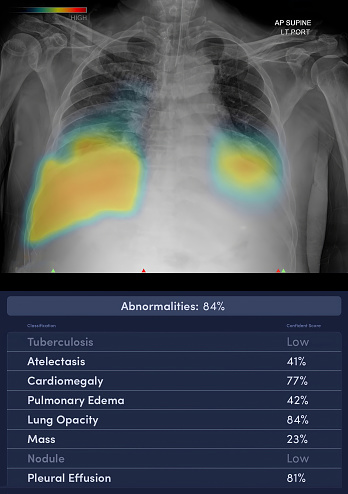 Chest x-ray image with (AI : Artificial Intelligence) report.