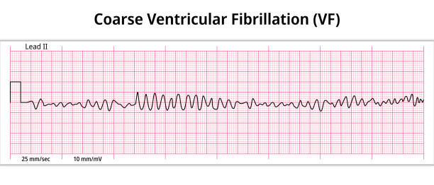 istock ECG Coarse Ventricular Fibrillation - 8 Second ECG Paper - Electrocardiography 1501143132