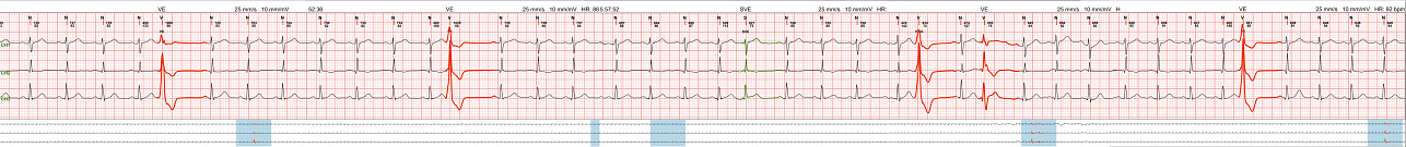 Electrocardiography ECG test patient with charts scientific cardiograms from heart wave, graph on paper