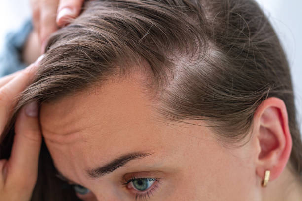 Woman suffering from hair loss. Treatment of hair problems Woman suffering from hair loss. Treatment of hair problems comb over stock pictures, royalty-free photos & images