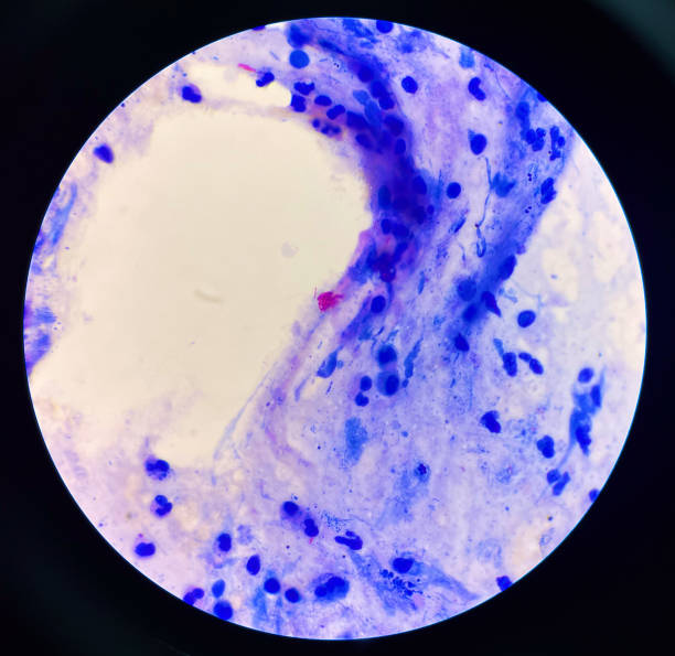 istock Red cell on center Mycobacterium Tuberculosis bacteria. 1501337461