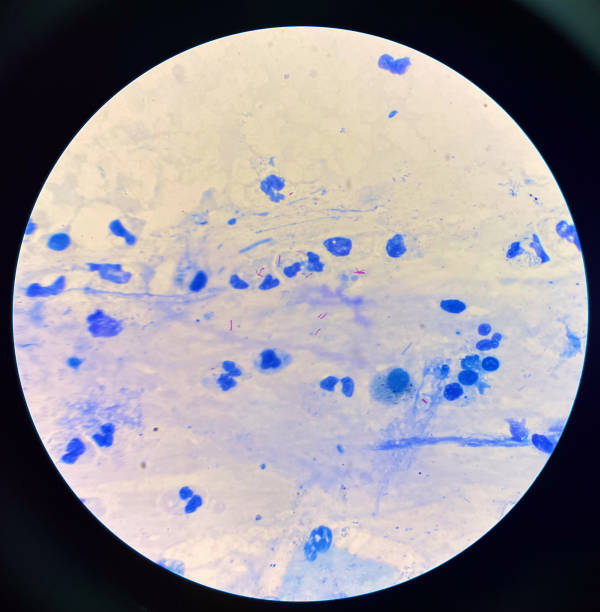 istock Red cell on center Mycobacterium Tuberculosis bacteria. 1501337462