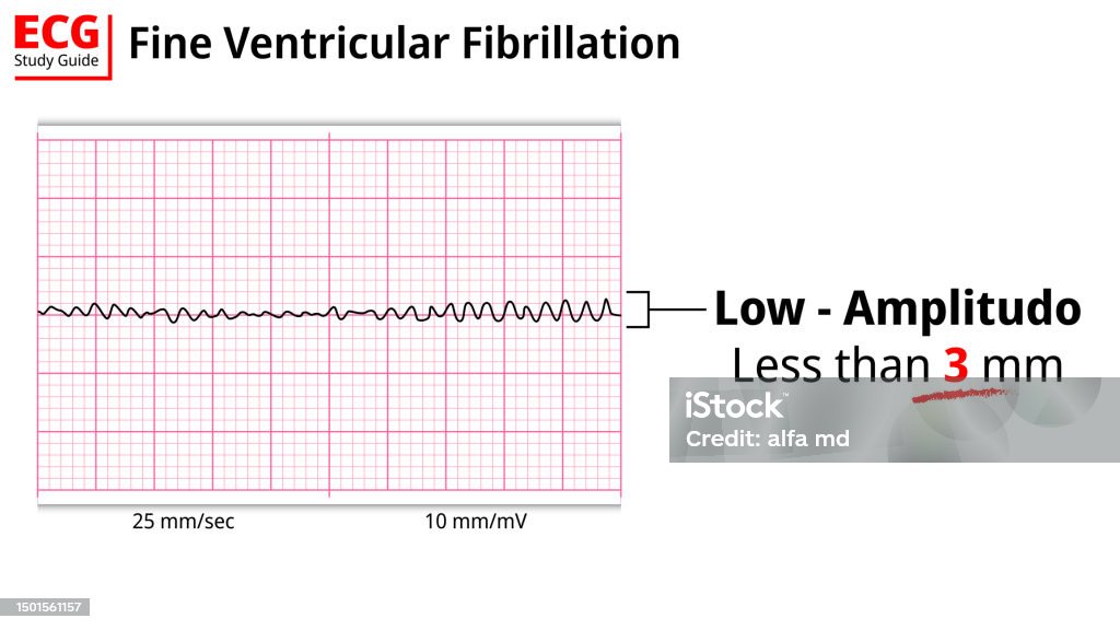 Vf Wave Fine Ventricular Fibrillation Ecg