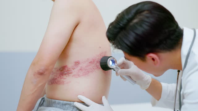 doctor examine shingles disease