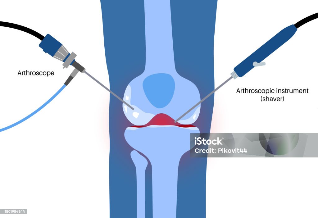 Knee Tensor Instrument Knee Joint Arthroscopy Stock Illustration - Download Image Now ...