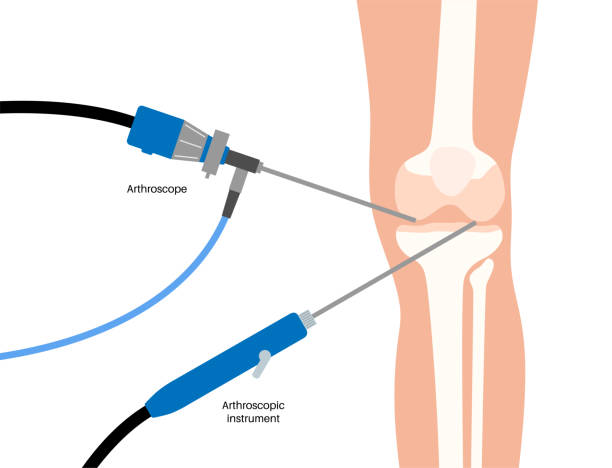 1,000+ Knee Arthroscopy Stock Photos, Pictures & Royalty-Free Images - iStock | Meniscus, Knee replacement, Arthroscopic surgery