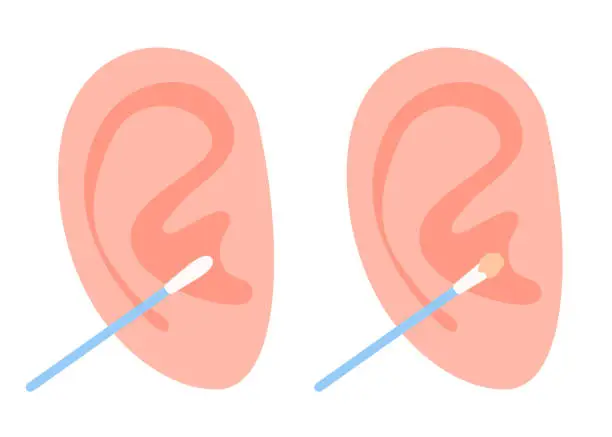 Vector illustration of Ear stick for cleaning ear. Clean and dirty cotton swab. Hygiene and health care of cotton buds. Vector