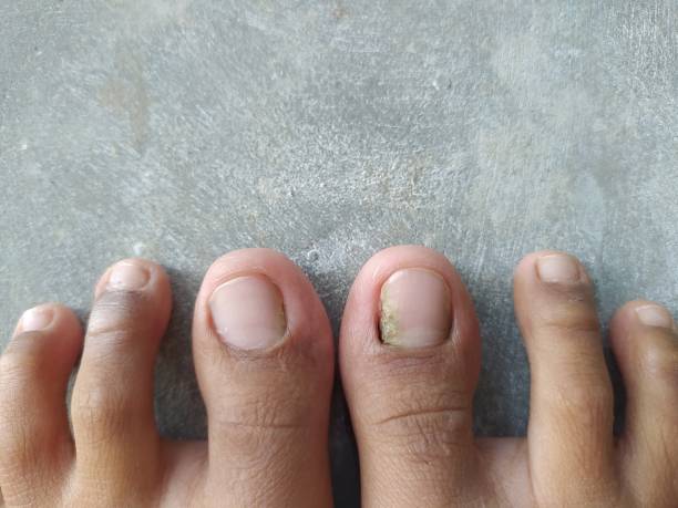 istock Toenail infected with fungus 1502373022