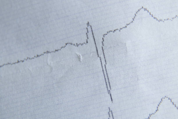 istock cardiogram on paper as background macro photo 1502765336