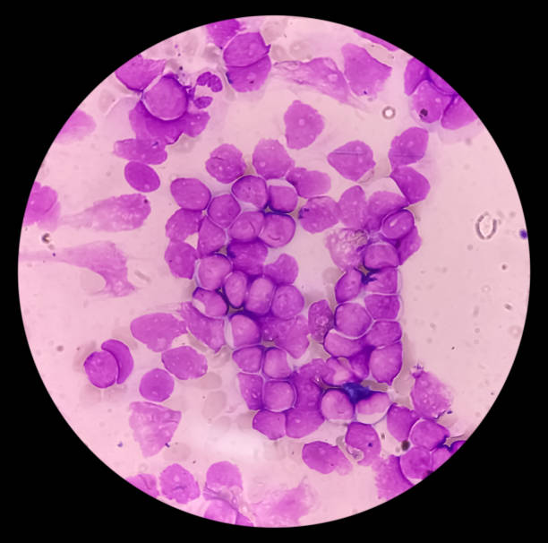 острый лейкоз, олл (острый лимфобластный лейкоз), мазок периферической крови, микроскоп под 100-кратным светом для диагностики острого лейко� - 2548 стоковые фото и изображения