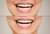 close-up photo of female teeth before and after the installation of the bracket system.  The result of bite correction.