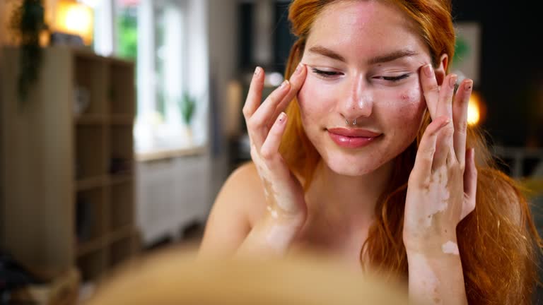 Woman with vitiligo and acne on her face, doing a skin care in her home