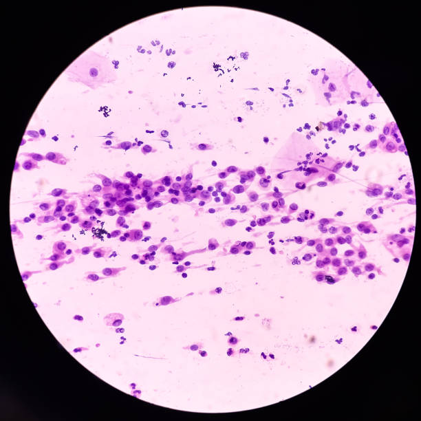 istock Pap's smear. Inflammatory smear with HPV related changes. Cervical cancer. 1502883543
