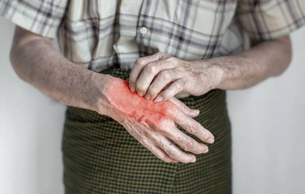 hombre asiático rascándose la mano. concepto de enfermedades cutáneas con picazón como sarna, infección por hongos, eczema, psoriasis, erupción cutánea, alergia, etc. - 3894 fotografías e imágenes de stock