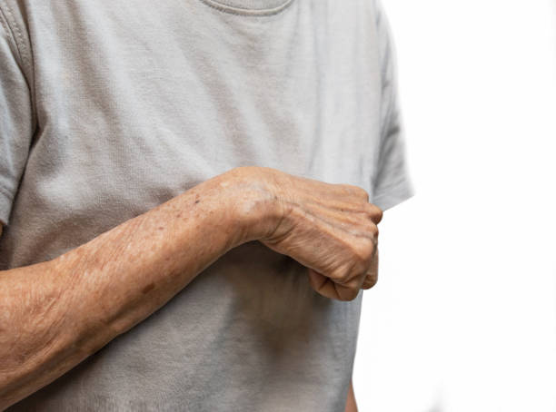 Volkmanns contracture in Southeast Asian old woman. Volkmann contracture in left upper limb of Southeast Asianold  woman. It is a permanent shortening of forearm muscles that gives rise to a clawlike posture of the hand, fingers, and wrist. atrophy stock pictures, royalty-free photos & images