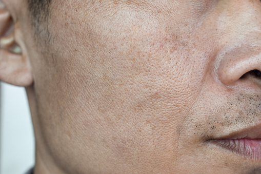 Fair skin with wide pores in face of Southeast Asian, Myanmar or Korean adult man.