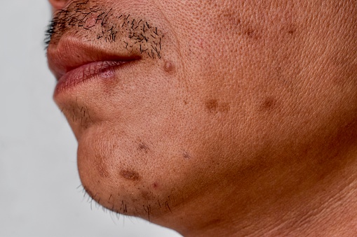 Small brown patches called age spots and scars on the face of Asian man. Liver spots, senile lentigo, or sun spots.