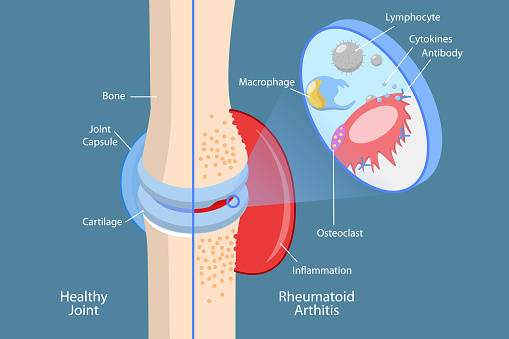 3D Isometric Flat Vector Conceptual Illustration of Rheumatoid Arthritis, Bones Pain, Injury and Inflammation