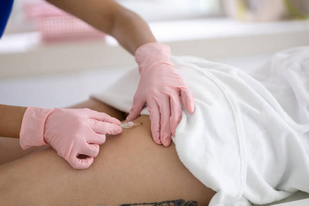 istock Nurse performing carboxytherapy on legs 1503021431