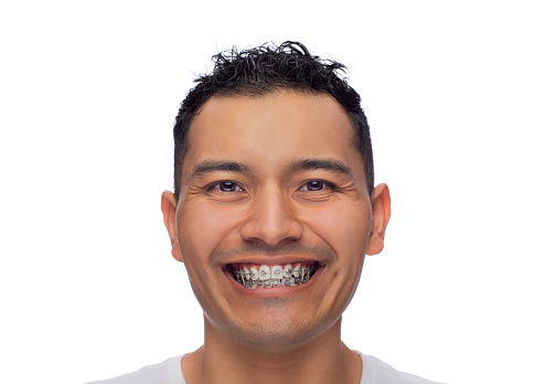 face of a young Latino man with dark skin smiles at the camera, shows if orthodontic treatment, stainless steel braces and garters, one person