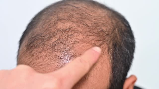Someone hand touching Asian baldness man scalp for checking hair loss problem.