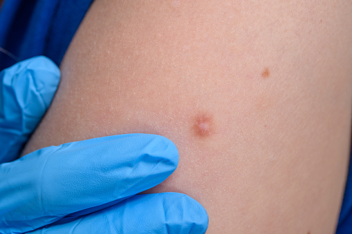 Examination of a skin lesion by a dermatologist hard fibroma, closeup