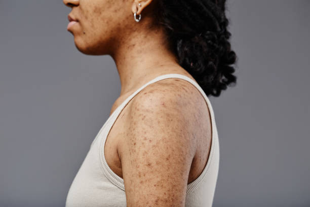 istock Woman with acne scars 1503224920