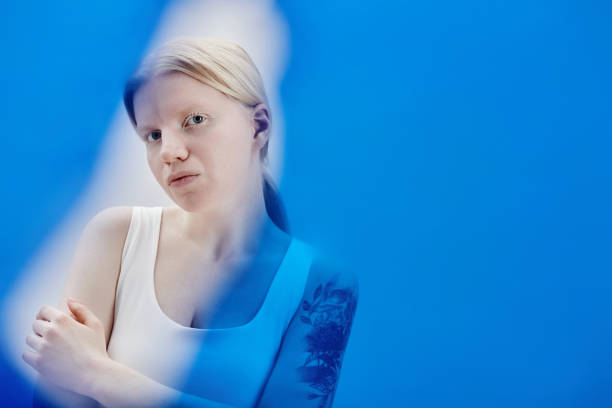 istock Girl with albinism posing in color blue 1503224955