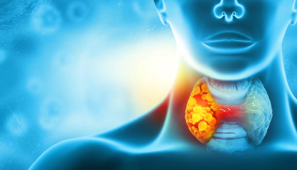 istock Thyroid gland cancer. showing thyroid gland with tumor. 3d illustration 1503304579