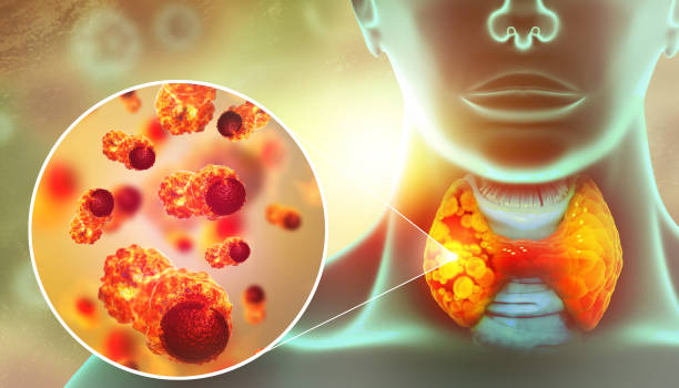 istock Thyroid gland cancer. showing thyroid gland with tumor. 3d illustration 1503304582