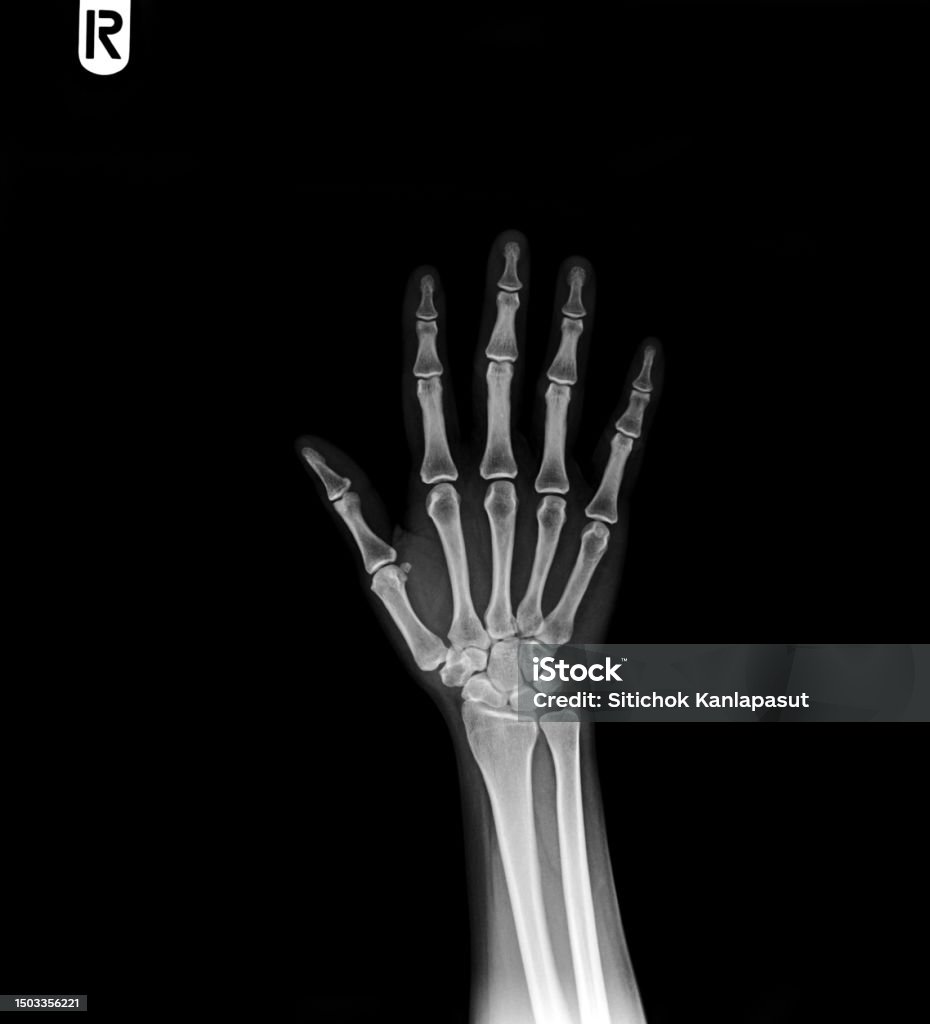 Normal Full Hand Xray Hands Normal Human Hands Stock Photo - Download Image Now ...