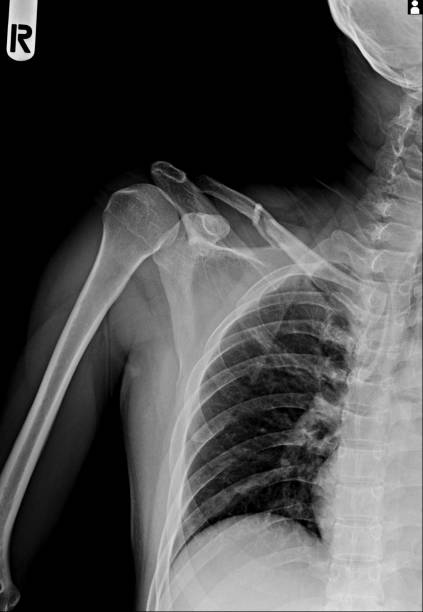 istock Film chest x-ray PA upright show normal chest isolate 1503356271