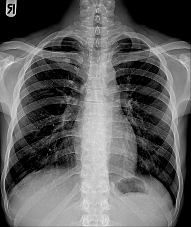 Film chest x-ray PA upright show normal chest isolate
