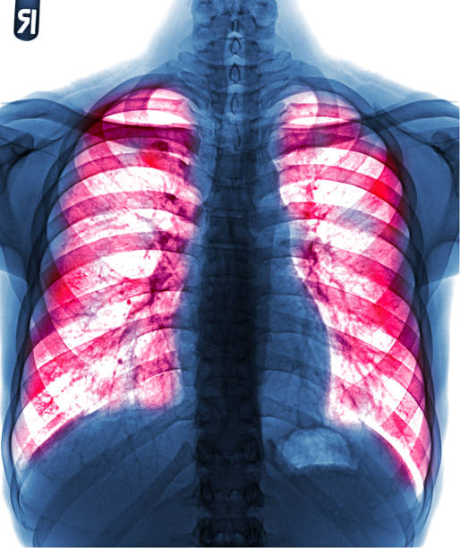 폐결핵 . 필름 흉부 엑스레이 쇼 섬유증, 간질 침윤 모두 폐 - interstitial 뉴스 사진 이미지