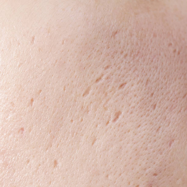 Close up of woman face has problems with skin on her face. Problems with acne and scar on the female skin. stock photo