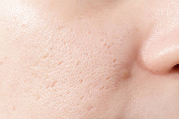 Close up of woman face has problems with skin on her face. Problems with acne and scar on the female skin. stock photo