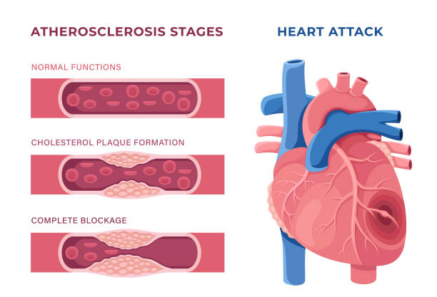 koncepcja zawału serca. niezdrowe serce. serce z blaszką miażdżycową. - cholesterol atherosclerosis human artery illness stock illustrations