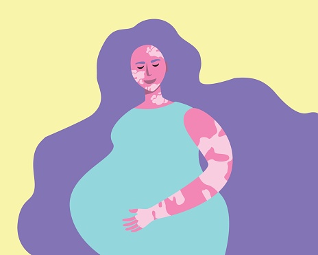 Pregnant woman with vitiligo as a concept of diverse childbearing, flat vector stock illustration