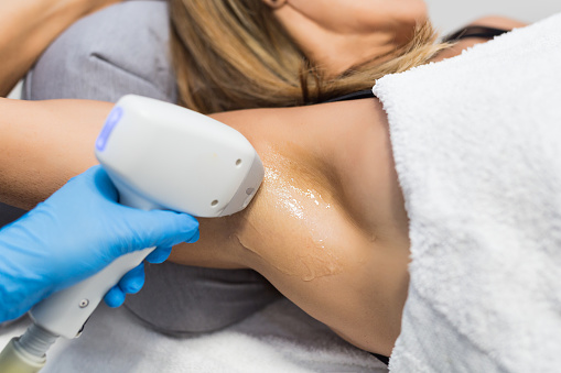 Armpit laser hair removal process - Buenos Aires - Argentina