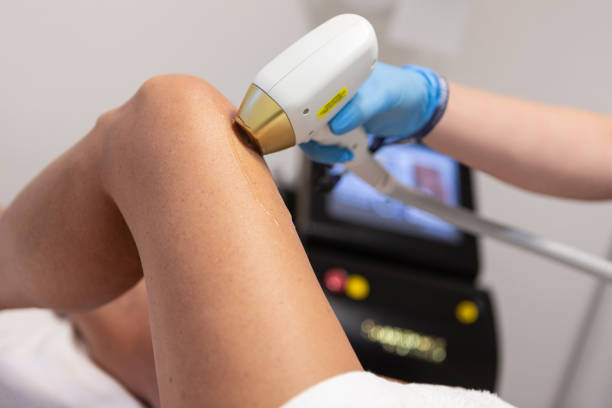 процесс лазерной эпиляции ног - laser therapy medical laser light therapy стоковые фото и изображения