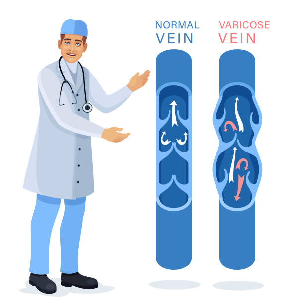 illustrations, cliparts, dessins animés et icônes de médecin examinant et diagnostique les maladies des vaisseaux sanguins et des veines. traitement des varices. - valvule humaine