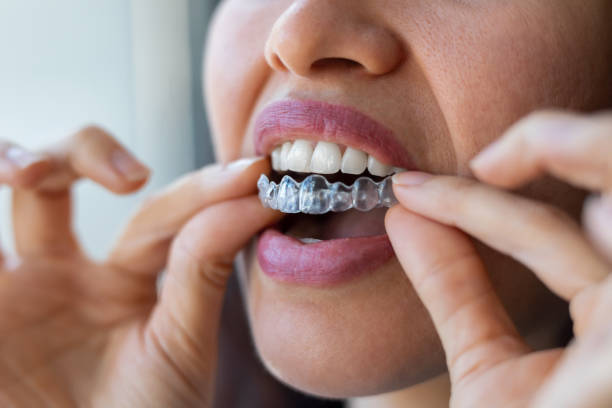 istock Woman wearing orthodontic silicone trainer. Invisible braces aligner. 1504174565