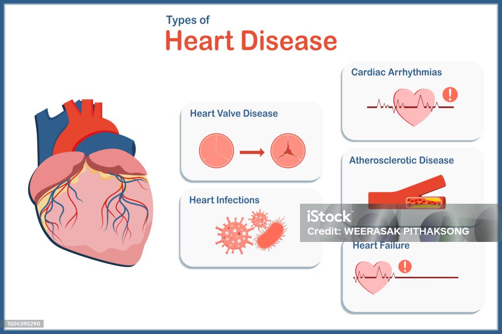 Types Of Heart Disease Stock Illustration Download Image Now types-of-heart-disease-stock-illustration-download-image-now