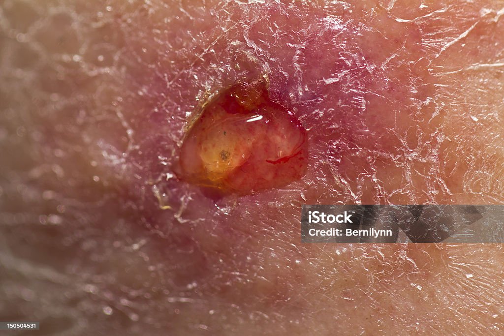 Ulceration An ulcerated leg sore Ulcer Stock Photo